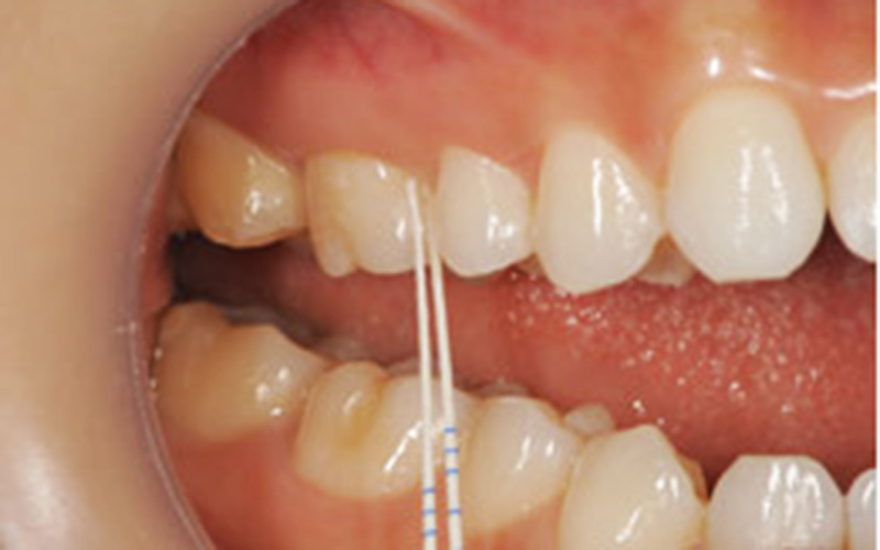 PRT　歯周病リスクテスト