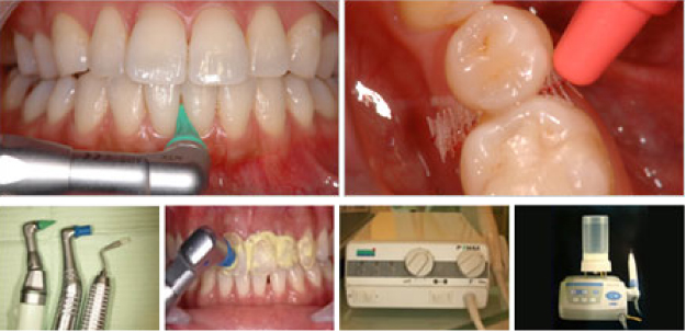 3.歯科衛生士によるプロフェッショナルケア