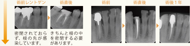 虫歯の進行度