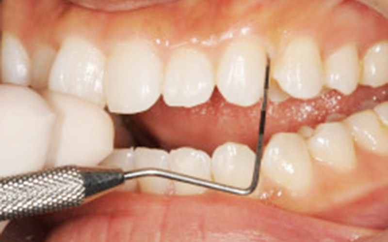 歯周病が進行する代表的な原因