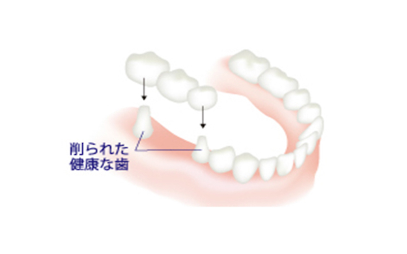 歯を失った場合