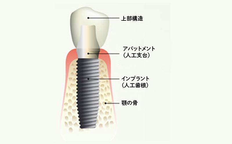 インプラントとは